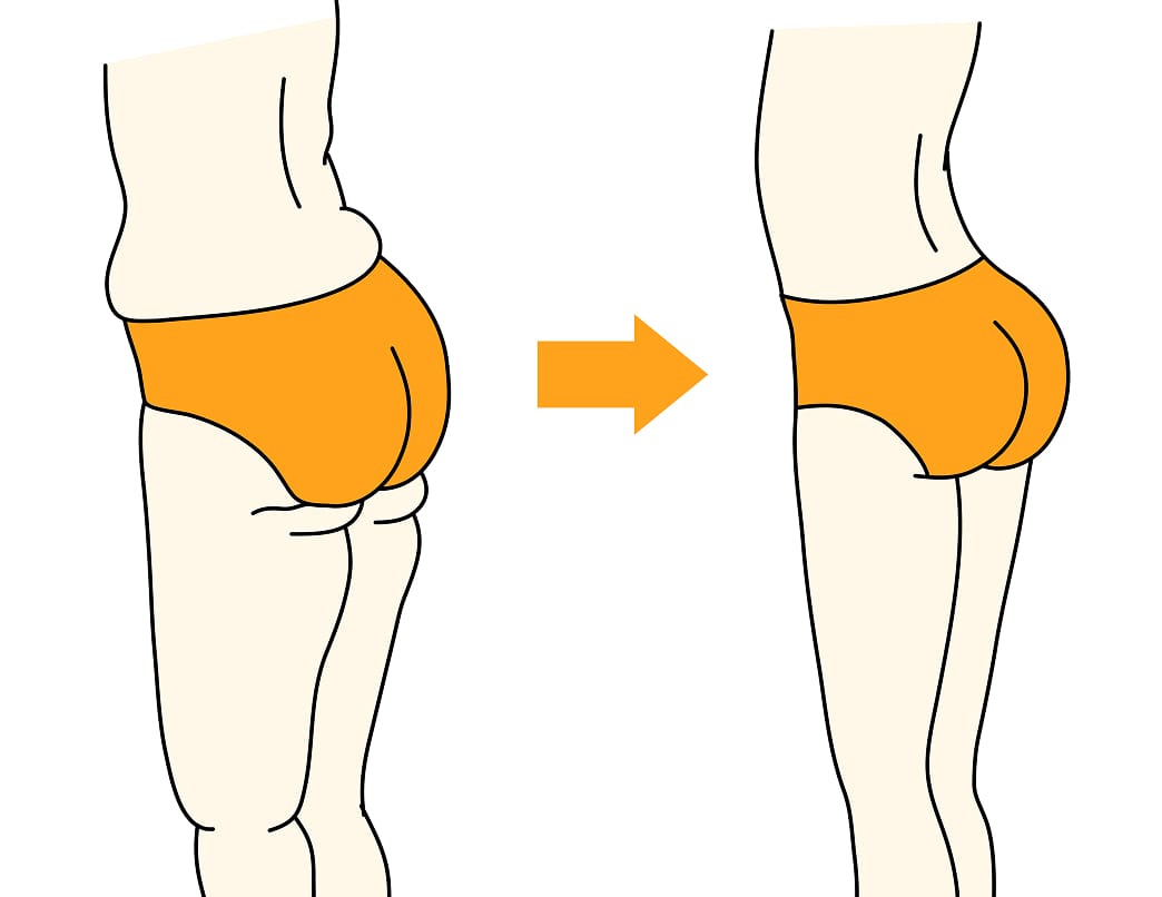 脂肪冷却（クルスカ）が選ばれる理由