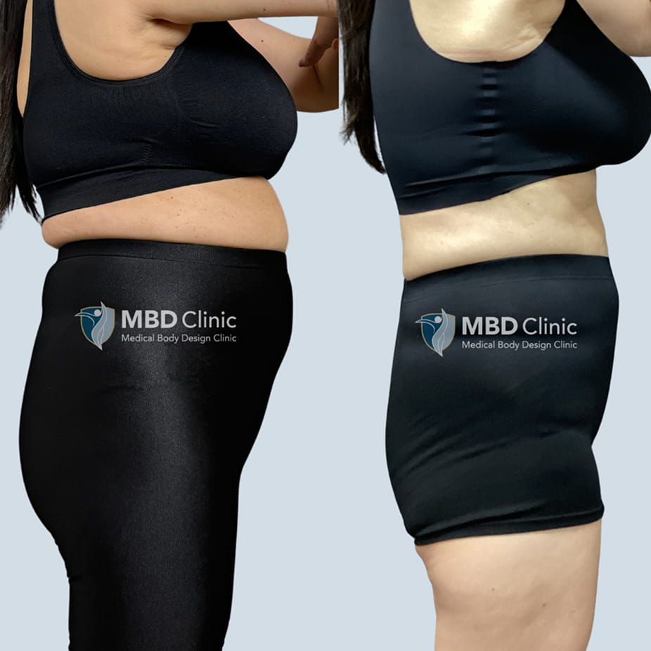 医療ダイエットモニター募集自己流で限界を感じている方へ
