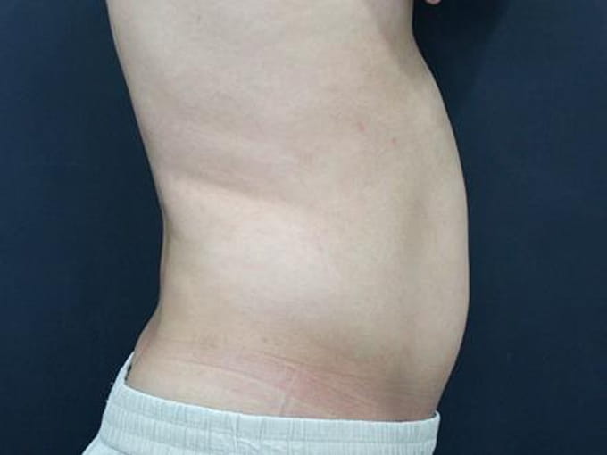 35歳 男性　6回　7日後 before