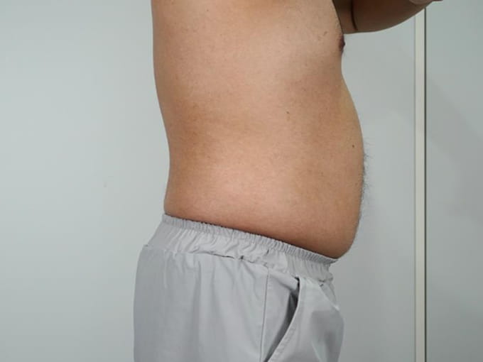 34歳 男性　5回　3～4日後 before