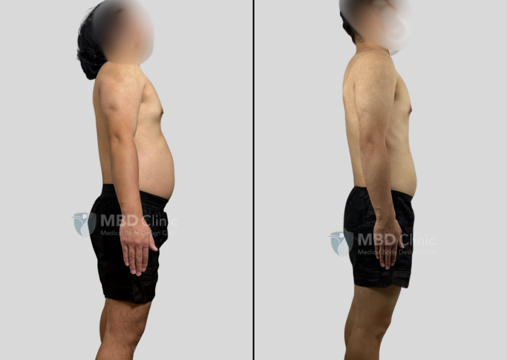 医療ダイエットの効果実感